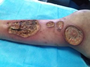 壞疽性膿皮病 壞疽性膿皮病