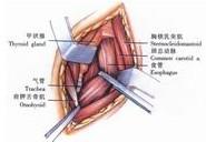 示意圖5:在氣管後方提出食管