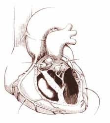 心內膜彈性纖維增生症