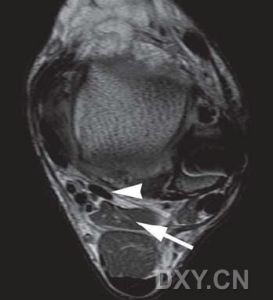 拇長伸肌 拇長伸肌