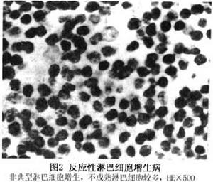 眼眶非霍奇金惡性淋巴腫瘤