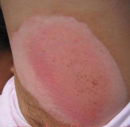 色素缺失症 色素缺失症