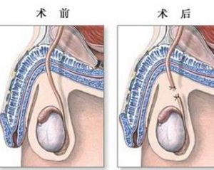 節育手術 節育手術