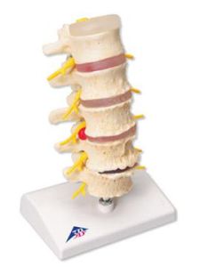 脊柱退行性疾病