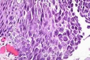 生殖器皰疹 生殖器皰疹