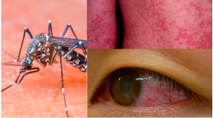 茲卡病毒 茲卡病毒