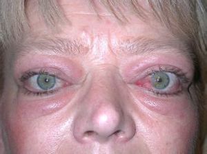 眼球突出 眼球突出