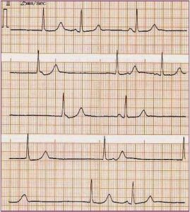 竇性停搏 竇性停搏