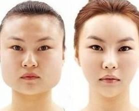 瘦臉手術 瘦臉手術