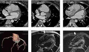 致心律失常性右室心肌病 致心律失常性右室心肌病