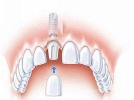 單顆種植牙齒 單顆種植牙齒