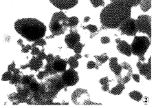 急性早幼粒細胞白血病