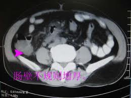 腸壁水腫增厚 腸壁水腫增厚