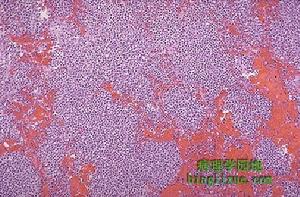 枸櫞酸桿菌肺炎