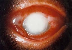 單純皰疹性角膜炎