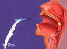 第六代低溫等離子消融術