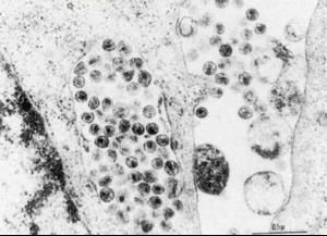 免疫缺陷病 免疫缺陷病