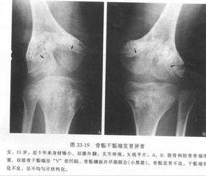 多發性骨骺發育不良