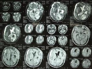 新生兒頭顱血腫