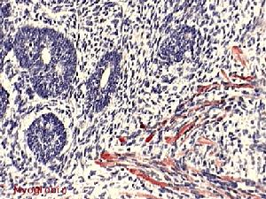 腎母細胞瘤