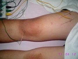 格里-巴利綜合症 格里-巴利綜合症