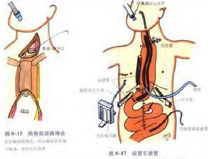 腐蝕性食管灼傷