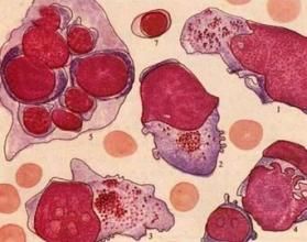 全血細胞減少症 全血細胞減少症