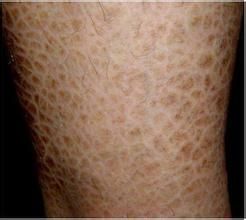 迴旋形線狀魚鱗病 迴旋形線狀魚鱗病