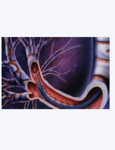 靜脈血栓 靜脈血栓