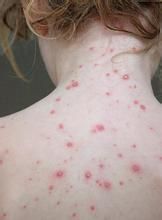 小兒紫斑濕疹綜合徵