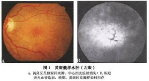 黃斑囊樣水腫