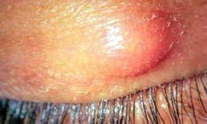 胞瞼痰核 胞瞼痰核