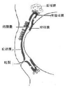 流行性角結膜炎