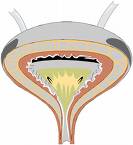 老年人慢性腎盂腎炎