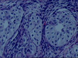 左附屬檔案囊腫 左附屬檔案囊腫