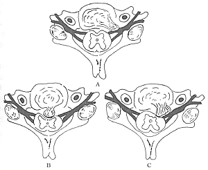 腰椎間盤突出症