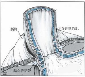 嬰幼兒胃食管反流