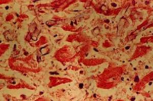 急性粒細胞缺乏 急性粒細胞缺乏