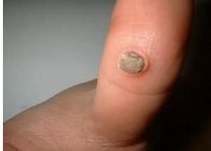 疣狀表皮發育不良