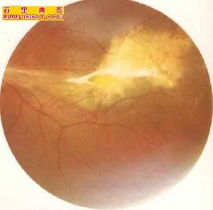 視網膜靜脈周圍炎 視網膜靜脈周圍炎