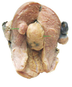 （圖）肝海綿狀血管瘤
