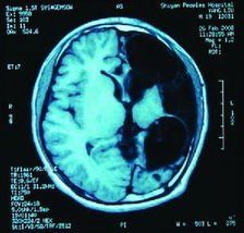 腔隙性梗死 腔隙性梗死