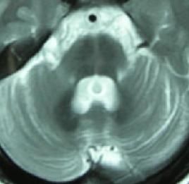 夏伊-德雷格綜合症