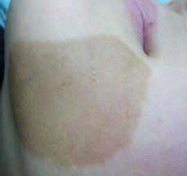 牛奶咖啡斑 牛奶咖啡斑