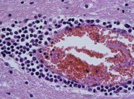 腦膜刺激症狀 腦膜刺激症狀