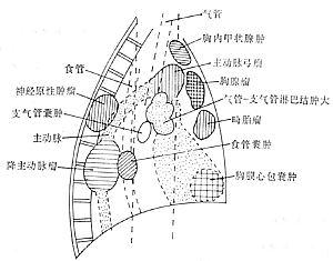 繼發性縱隔感染