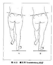 trendelenburg征 trendelenburg征