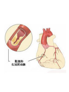 心肌缺血