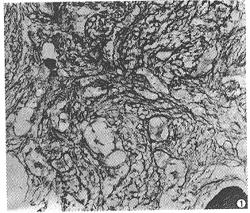 慢性粒細胞白血病