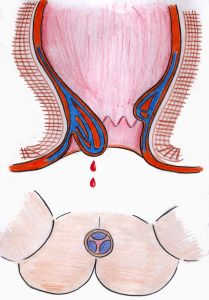 產後便血 產後便血